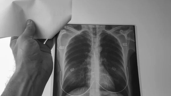 Läkare Kontrollerar Röntgenfilmen Lungorna Och Hjärtat Hos Kvinnlig Patient Ett — Stockfoto
