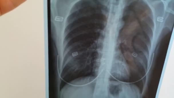 Лікар Перевіряє Рентгенівську Плівку Легенів Серце Жінки — стокове відео