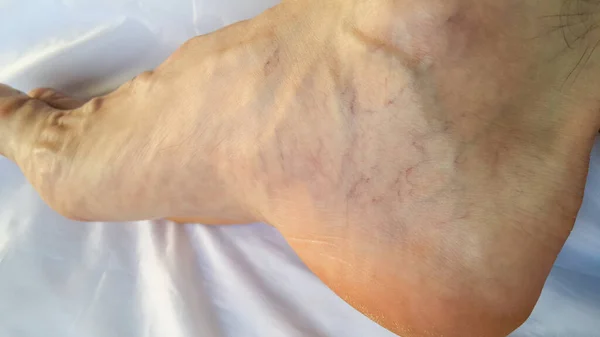 Leg. Varicose veins. Phleborism. Thrombophlebitis. Red and blue capillaries are visible on the heel of the foot. A trace on the skin from the expansion of the blood vessels of the veins.