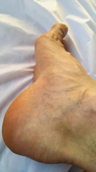 Leg. Varicose veins. Phleborism. Thrombophlebitis. Red and blue capillaries are visible on the heel of the foot. A trace on the skin from the expansion of the blood vessels of the veins.