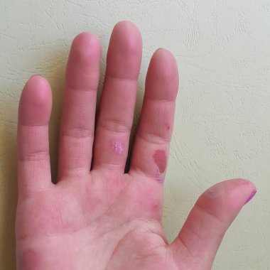 Kızın avucundaki nasırlar ağrıya neden oluyor. Sıkı çalışan bir kadının ellerindeki yırtık deri. Zor bir hayat kavramı. İnsanların acı ve ıstırabı. Şişmiş cilt.