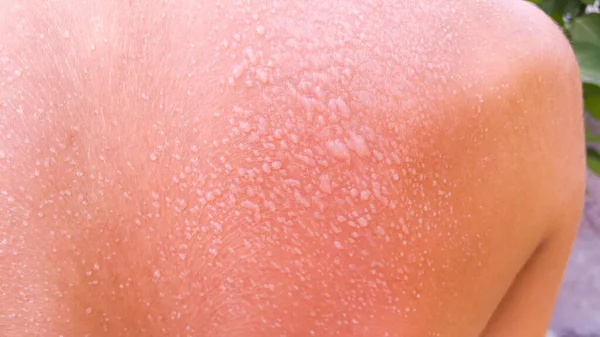 Blisters Back Sunburn Young Guy Vacation Beach Caught Fire Rays — Stock Photo, Image