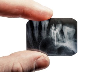  fingers are holding the x-ray of teeth isolated on background clipart