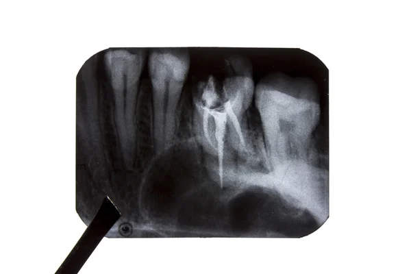 The forceps is holding an x-ray of teeth — Stock Photo, Image