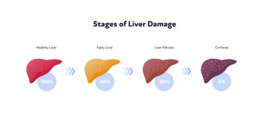 Liver damage infographic. Vector flat illustration. Anatomical human organ. Stages of cirrhosis disease from healthy to fatty and fibrosis. Arrow and percent sign. Design for health care, education clipart