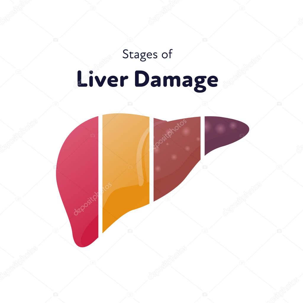 Liver damage infographic. Vector flat illustration. Anatomical human organ. Stages of cirrhosis disease from healthy to fatty and fibrosis on parts of liver. Design for health care, education