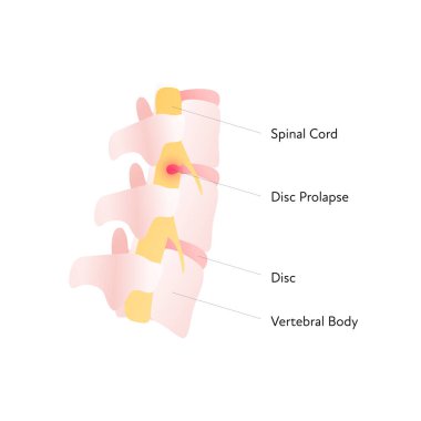 Omurilik vektörü düz anatomik illüstrasyon ile metin ve disk sarkması. Bilim, biyoloji, sağlık hizmetleri için tasarım.