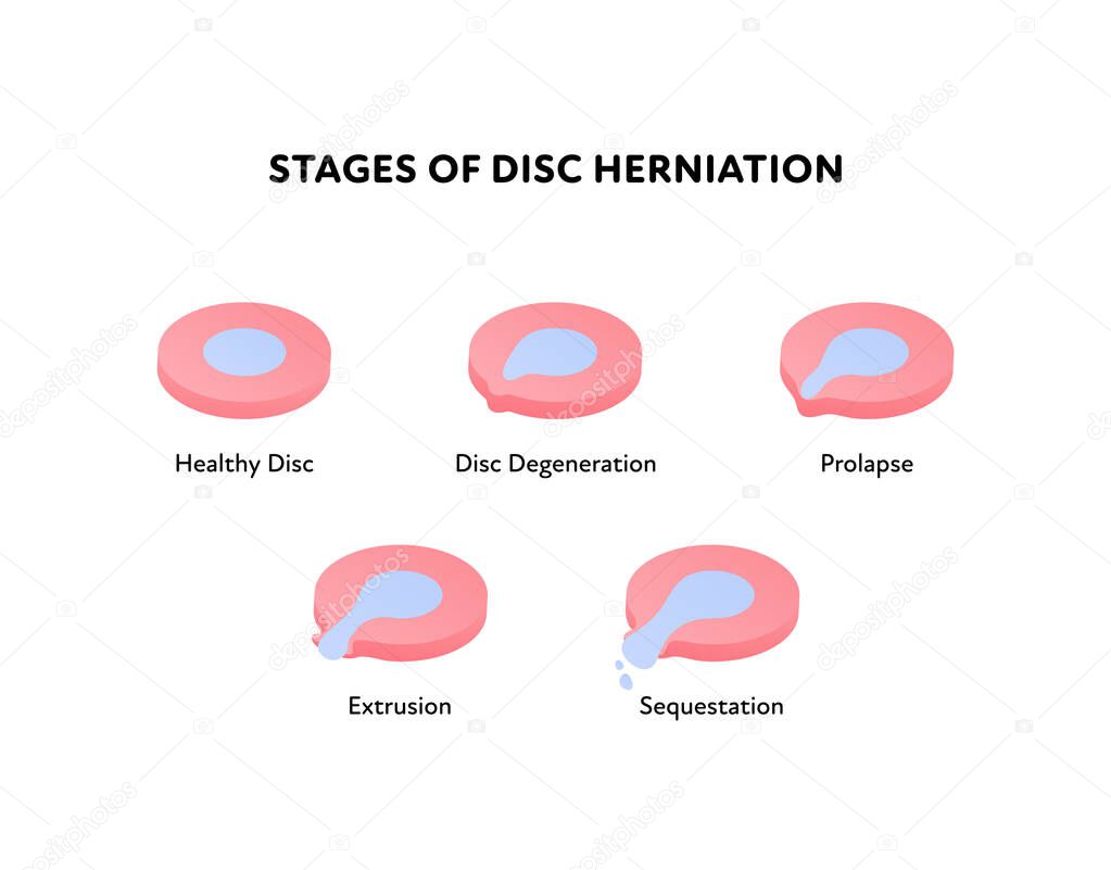 Spine disk stages of herniation. Vector flat anatomical illustration. Icon set. Healthy, degeneration, prolapse, protrusion, sequestation stage. Design for science, biology, health care.