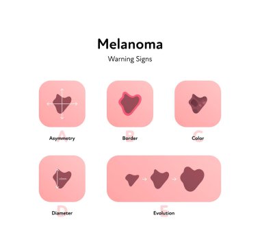 Melanoma cancer anatomical infographic poster. Vector flat medical illustration. Warning signs of tumor disease. Asymmetry, border, color, diameter. Design for healthcare, oncology, dermatology. clipart