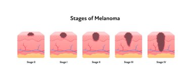 Melanoma kanseri anatomik bilgi afişi. Vektör düz tıbbi illüstrasyon. Tümör hastalığının aşamaları. Sağlık, onkoloji, dermatoloji için tasarım.