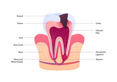 Tooth anatomy and decay chart. Vector biomedical illustration. Cross section with text isolated on white background. Inner teeth structure with caries and abscess. Design for healthcare, dentistry clipart