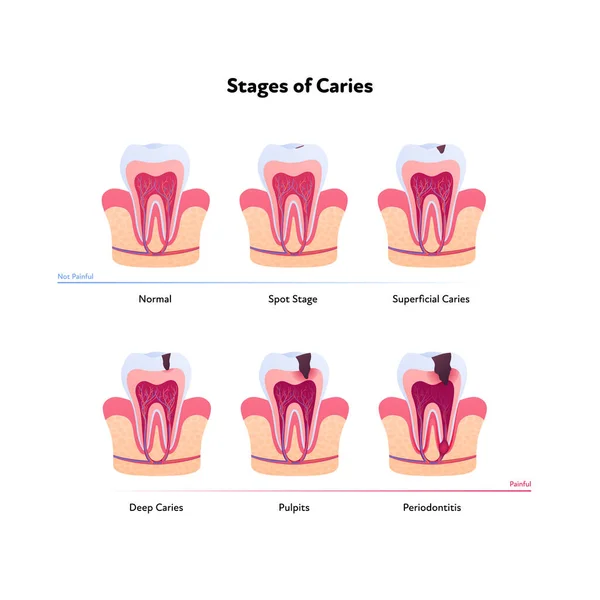 Anatomia Zębów Wykres Rozkładu Ilustracja Biomedyczna Wektora Przekrój Etapy Próchnicy — Wektor stockowy