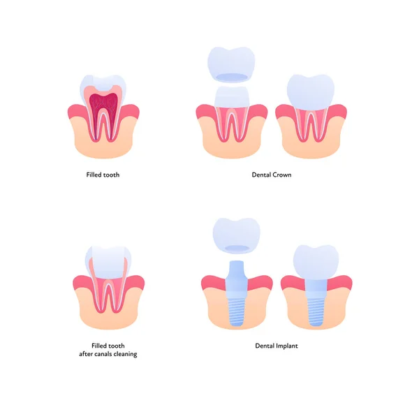Relleno Dental Carta Implantes Ilustración Biomédica Vectorial Sección Transversal Dientes — Archivo Imágenes Vectoriales