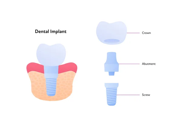 Cartilla Implantes Dentales Ilustración Biomédica Vectorial Sección Transversal Esquema Prótesis — Archivo Imágenes Vectoriales