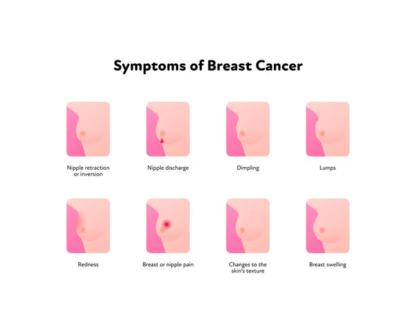 Συμπτώματα Καρκίνου Του Μαστού Infographic Διάνυσμα Επίπεδη Απεικόνιση Υγειονομικής Περίθαλψης — Διανυσματικό Αρχείο