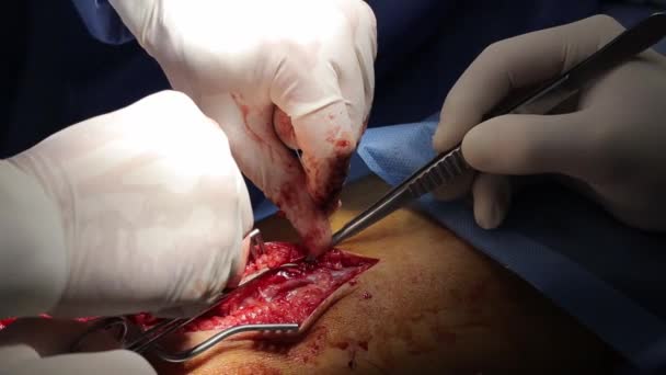 Sebész orvos visel speciális lámpa világítás segítségével elektromos kauterizáló szívműtét beavatkozás közelkép, nyílt köldökzsinór műtét minimálisan invazív műtét — Stock videók
