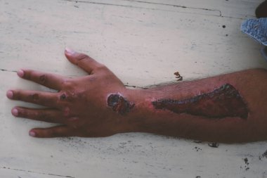 Hasta kolunda yara, pansuman, enfeksiyon kontrolü..