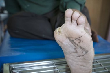 Ampüte olmuş diyabetik ayağın enfekte olmuş yarası, sağlık bakımı uzmanı.