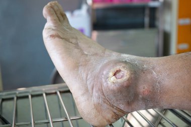 Diyabetik ayağın enfekte olmuş yarası, sağlık konsepti
