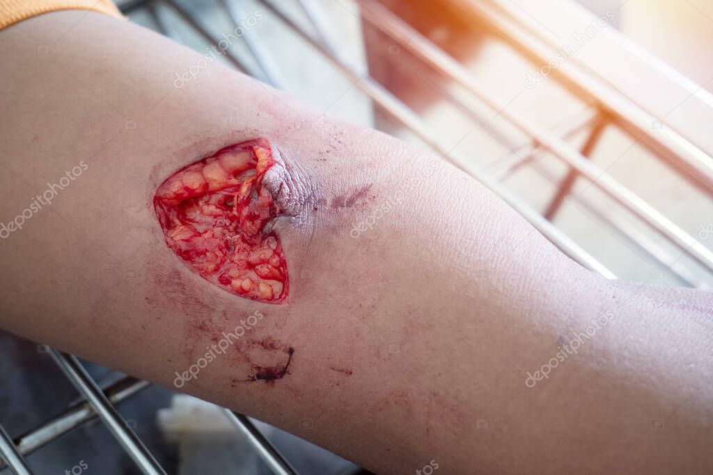 Cut wound caused from the accident