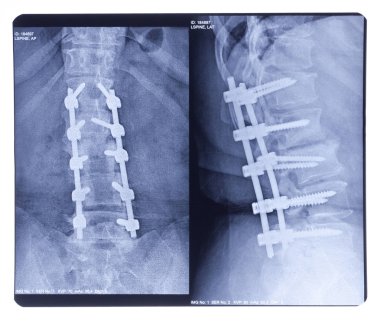 Scoliosis, X-ray clipart