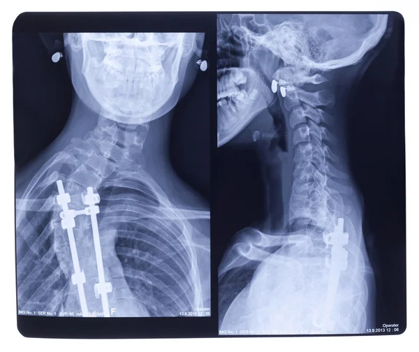 X-ray, Scoliosis — Stock Photo, Image