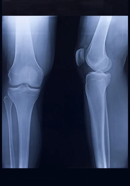 X-Ray, Knee — Stock Photo, Image