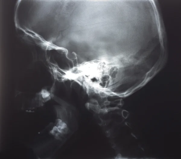 Røntgenbillede, menneskehoved - Stock-foto
