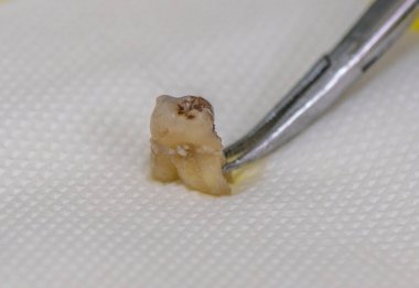 Kurşunlardan etkilenmiş insan dişi çıkarılmış.