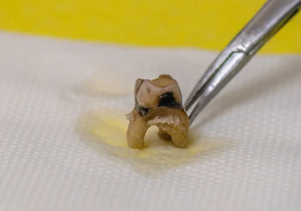 Dente Humano Extraído Afetado Pela Cárie — Fotografia de Stock