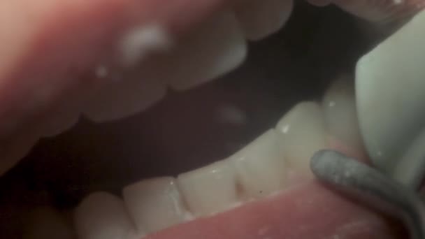 Close-up de limpeza dos dentes higienista Dental. — Vídeo de Stock