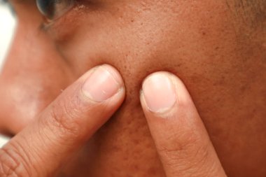 Sivilceye parmak basan ve ayrıntılı deriyi ortaya çıkaran bir insanın yüzüne aşırı yakın olmak.