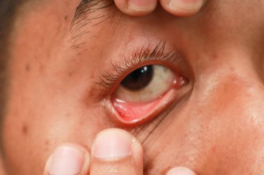 Şiddetli kızarıklık ve göz kapağı ve konjonktivitede şişkinlik gösteren bir göz aşırı yakın çekim