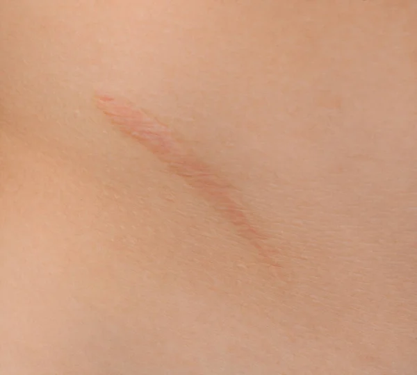 Healed scar after Appendicitis surgery. — Stock Photo, Image