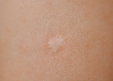 İnsan kolundaki BCG aşısının izi yakın plan..