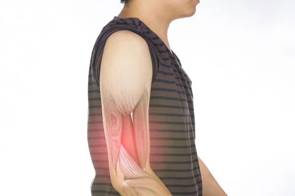 腕筋損傷白い背景腕の痛み — ストック写真