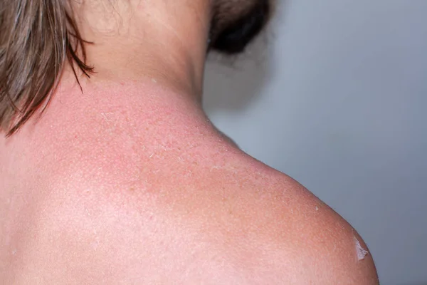 Ηλιακό Έγκαυμα Στον Ώμο Πάνω Στρώμα Του Δέρματος Ξεφλουδισμένο Κόκκινο — Φωτογραφία Αρχείου