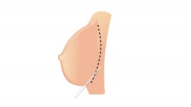 Göğüs büyütme. Genişleyen göğüsler. Geliştirilmiş Boyut, Şekil ve Ses. Geliştirilmiş büst. Göğüs implantı olan bir kadının tıbbi animasyonu. Göğüs implantları hareketli video 