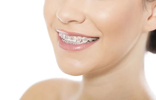 Beautiful young woman wearing braces — Stock Photo, Image