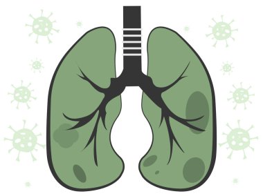 Ciğerlerine koronavirüs virüsü bulaşmış ve hasta.