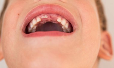 Bebek dişini kaybetmiş bir çocuğun gülümsemesi. Çocuk dişlerine dikkat et. Diş sağlığı ve diş hekiminde tedavi..