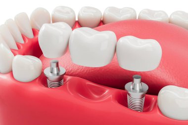 Diş implantı köprüsü, yapay dişlerle desteklenen kırmızı sakız modeli arka plan, oral rehabilitasyon konsepti. 3B Hazırlama