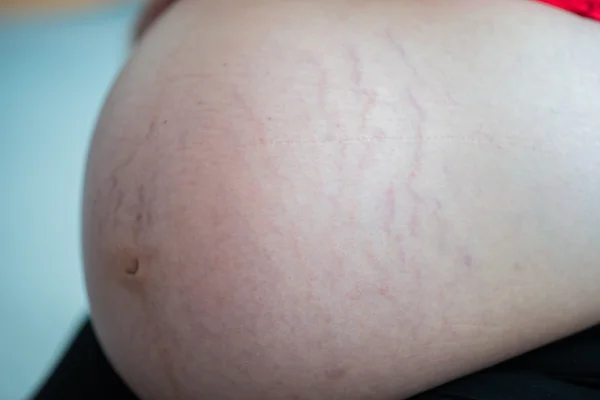 Pregnancy belly stretch marks skin close up - Stock Image. 