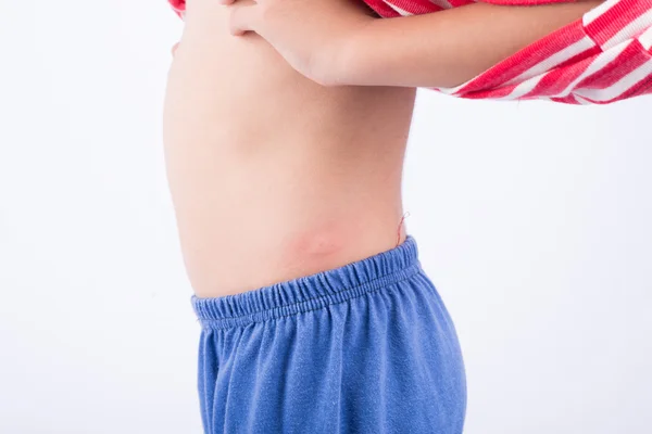 Αλλεργία σε παιδί πίσω από το κουνούπι — Φωτογραφία Αρχείου
