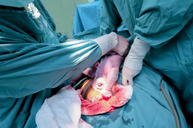 Sezaryen gebelik anne işlemi Oda doğum bebek yanlış pozisyonda--dan dip