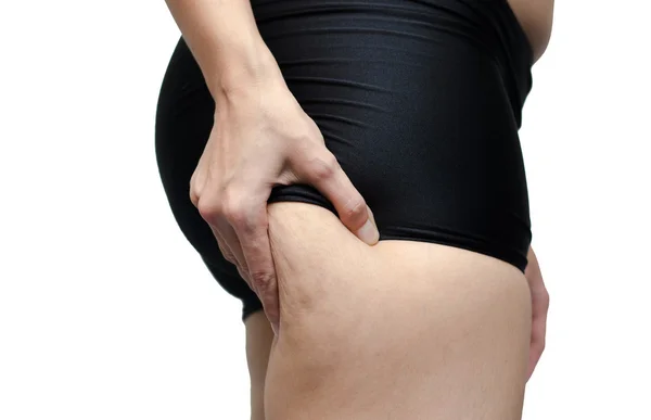 Donna mostrando la gamba con la cellulite — Foto Stock