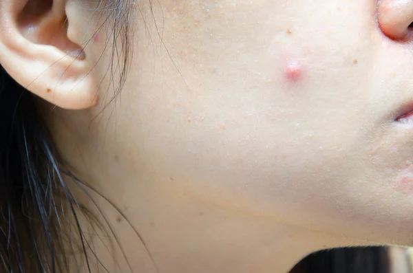 Grano en la cara de la mujer de cerca — Foto de Stock