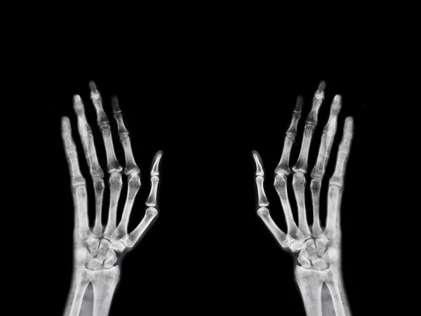 Handknochen-Röntgen — Stockfoto