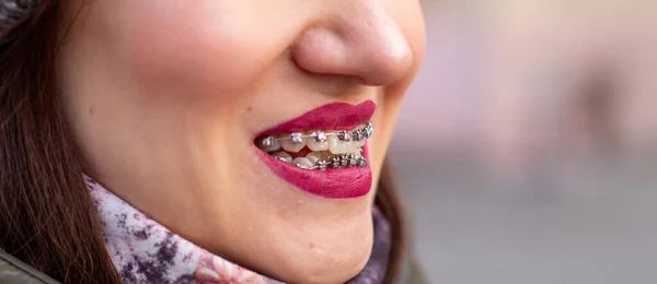 女の子の笑顔の口の中でブレースシステム 歯のマクロ撮影 赤い唇のクローズアップ 通りを歩いている女の子 — ストック写真