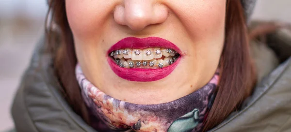 The brace system in the girl\'s smiling mouth, macro photography of teeth, close-up of red lips. Girl walking on the street